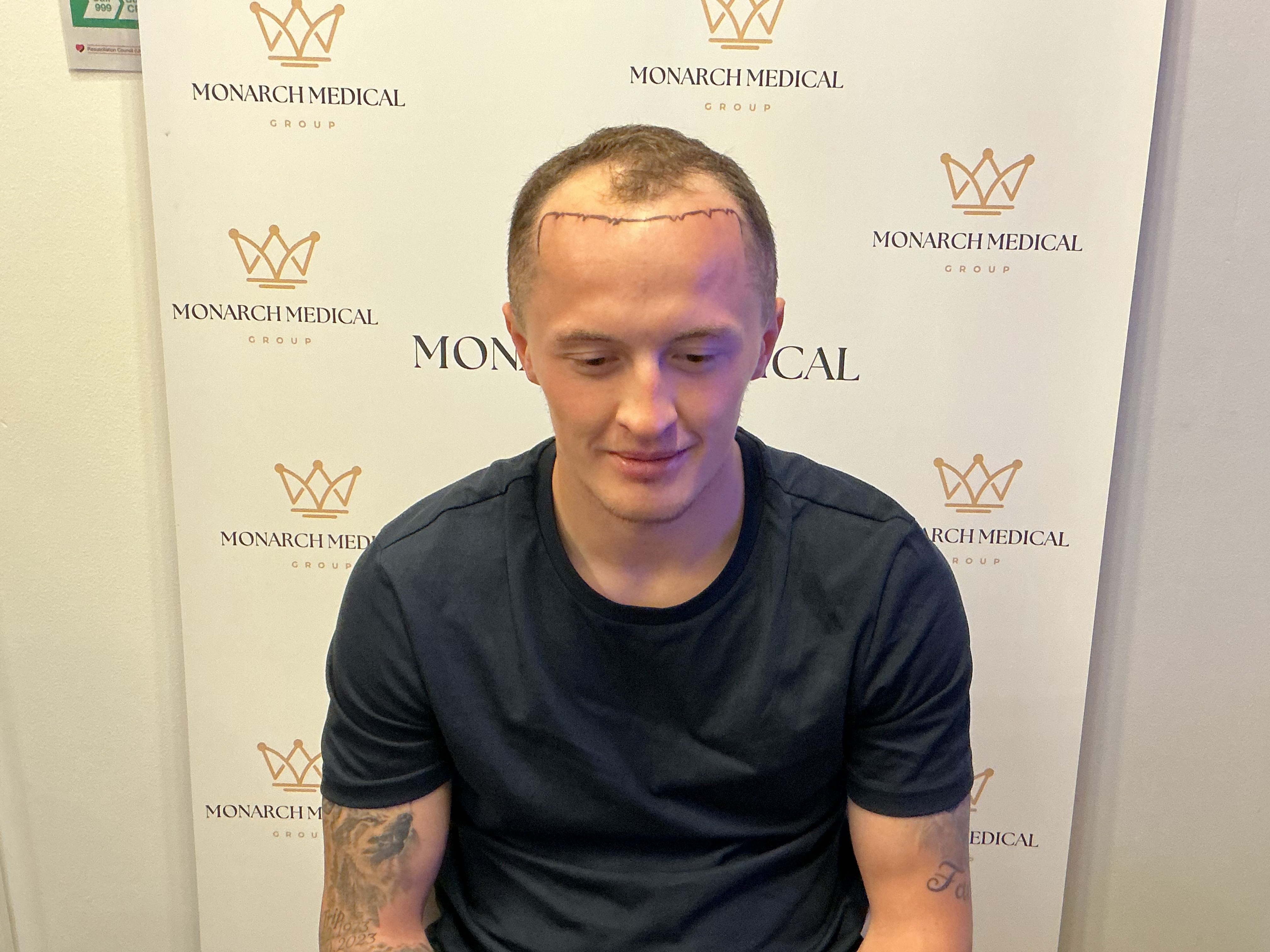 Advanced hairline recession — result photo 1